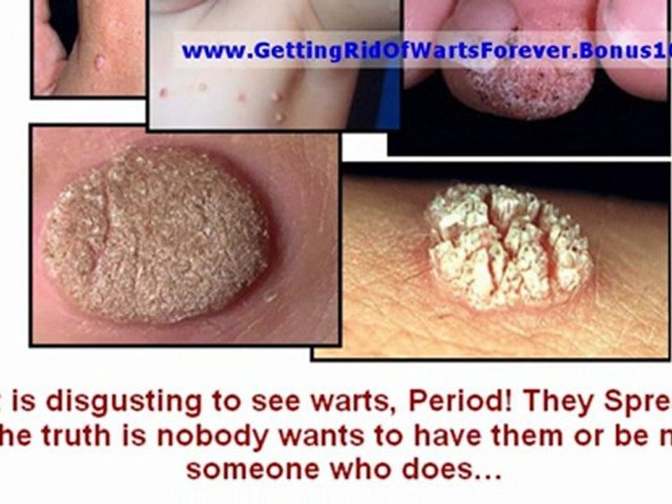 treatment of warts - home remedies for warts - how to remove skin tags yourself