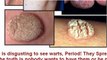 how to get rid of warts on hands - how to get rid of skin tags at home