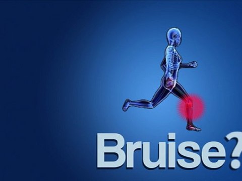 How to Get Rid of a Bruise Fast