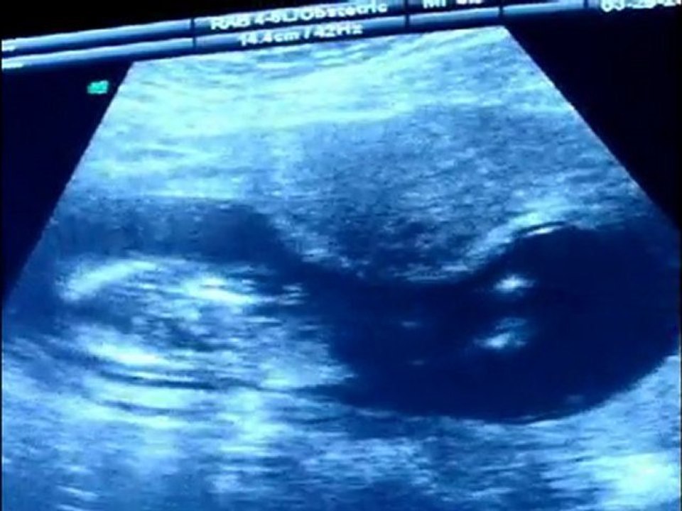 Baby ultrasound