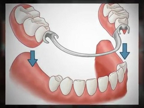 Calgary Dentures - Learn More About Your Calgary Dentures Options