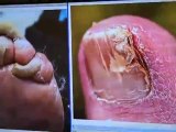 What is a fungal nail infection?-Minnesota Podiatrist Explains