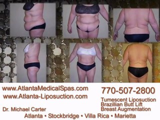 Atlanta Liposuction, Dr. Michael Carter - See Results Vol. 2