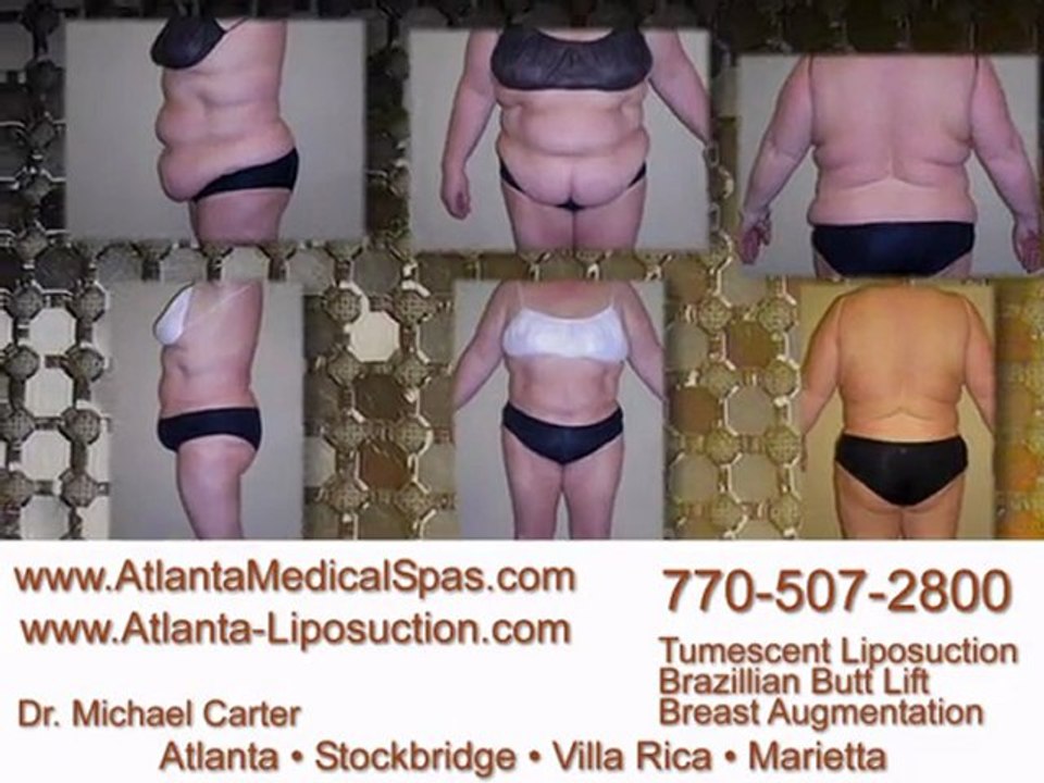 Atlanta Liposuction, Dr. Michael Carter - See Results Vol. 2
