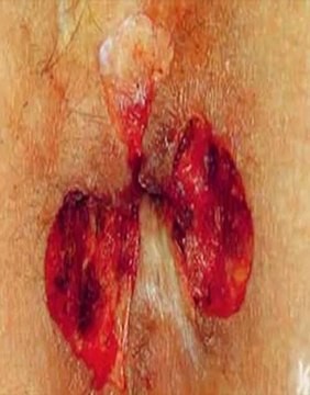 Como curar las hemorroides en 48 horas o menos / hemorroides