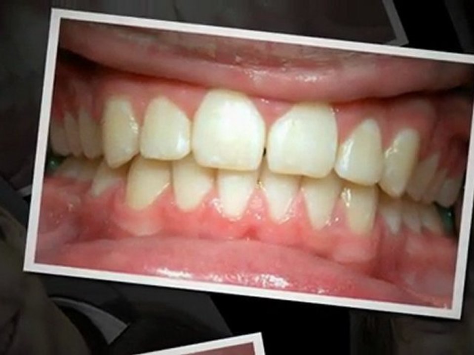 Parker Orthodontist:  Imagine Your New Smile!