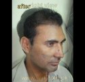 Hair Transplant Clinics in Pakistan,Pakistan Hair Transplant clinic,Hair transplant Doctor Pakistan