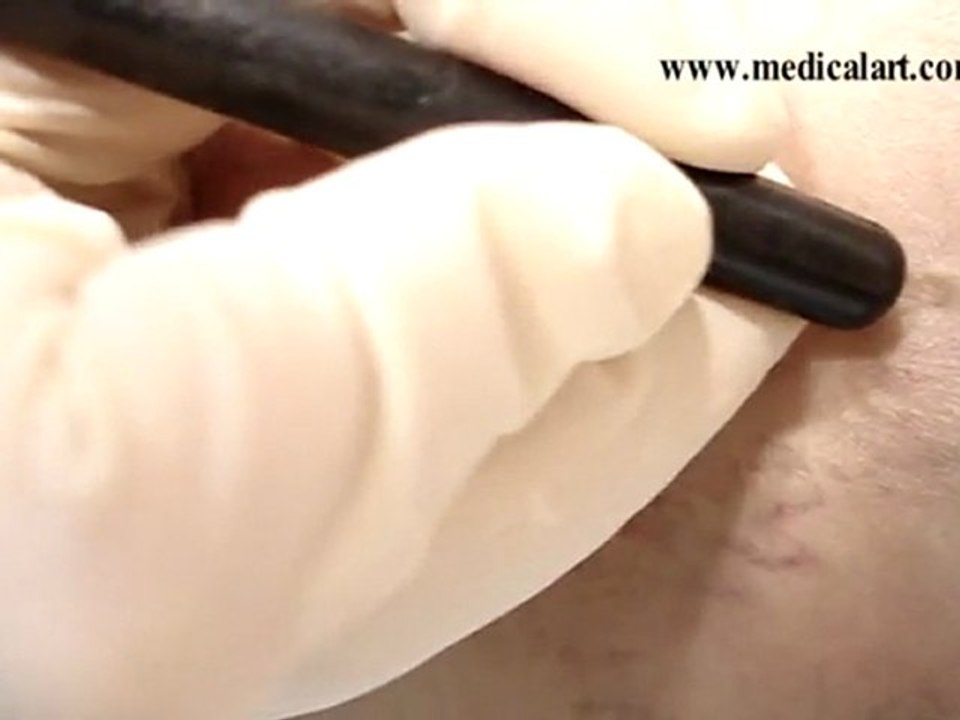 Varis Radyo Frekans ve Kılcal Varis Tedavisi www.varisistanbul.com