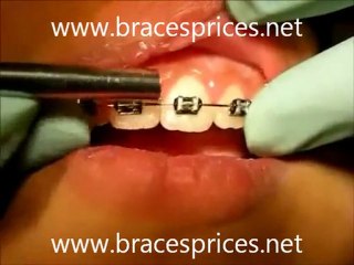 Problems With Braces like Sore, Pain, Poking, Broken Bracket
