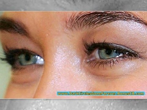 dark circles treatment - dark circles around eyes - how to remove dark circles