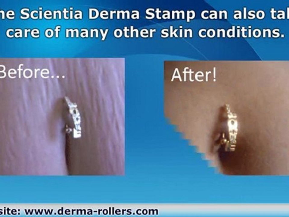 Derma Stamp for Getting Rid of Stretch Marks