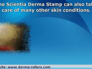 Get Rid of Acne Scars with the Derma Stamp