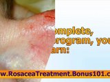 rosacea natural treatment - treatment for rosacea - acne rosacea treatment