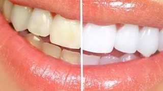 Most Effective Teeth Whitening