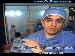 Ecuador Vitrectomy - Dr PONCE