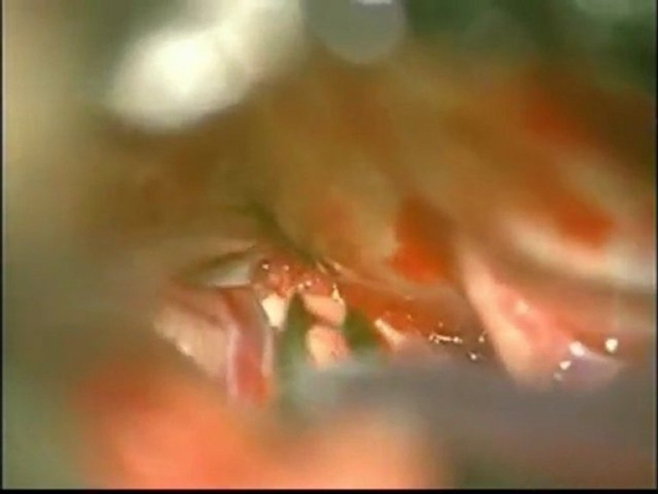 Trigeminal Neuralgia - Microvascular Decompression Surgery