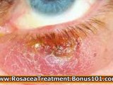 natural rosacea treatment - how to get rid of rosacea - natural treatment for rosacea