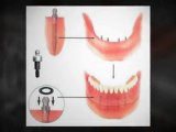 Dentures Over Implants - Learn More About Your Dentures Over Implants Options in Calgary