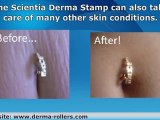 Derma Stamp for Tummy Tuck Scars