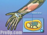 Carpal Tunnel Syndrome Repair Surgery - Body