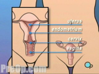 Dilation and Curettage D and C Surgery - Body