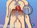 Cardiac Catheterization Angiography - Body