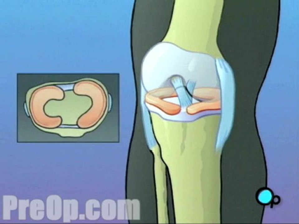 Anterior Cruciate Ligament Arthroscopic Repair Surgery - Body