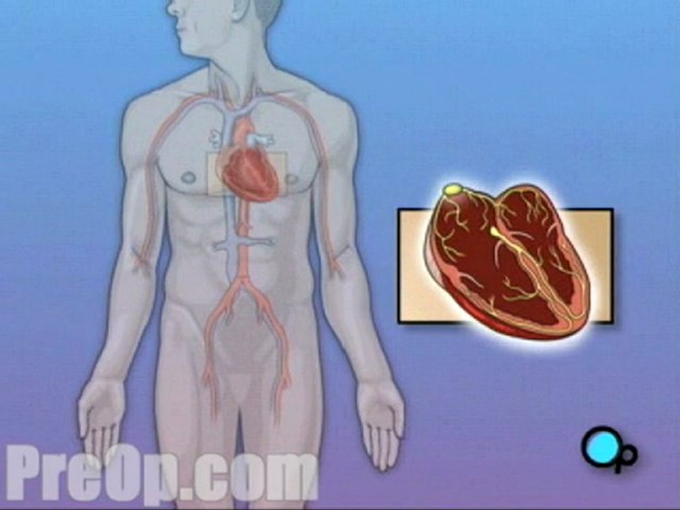 Permanent Pacemaker Implant - Body
