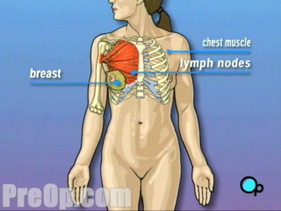 Mastectomy Total Surgery - Body
