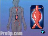 Abdominal Aortic Aneurysm - Open Repair - Body