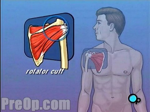 Rotator Cuff Repair - Arthroscopic - Body