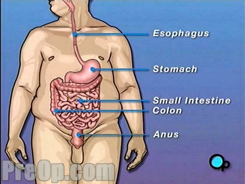 Gastric Adjustable Band Laparoscopic Surgery - Body