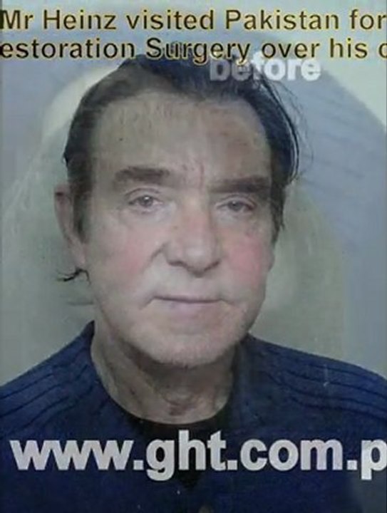 FUE hair transplant in pakistan,hair transplant in pakistan,pakistan hair transplant