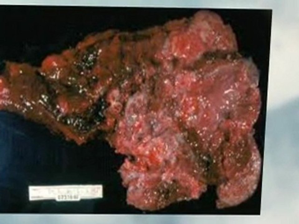 Asbestos Abatement Normal