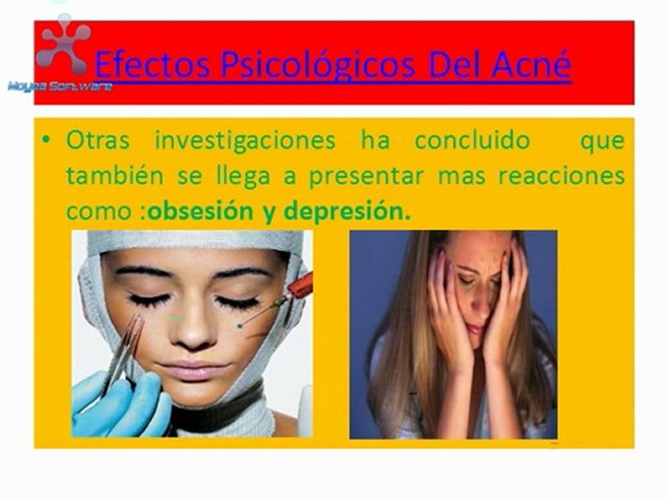 Efectos Psicologicos Del Acne
