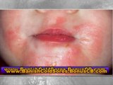 treatment for cold sores - best cold sore treatment - home remedy for cold sores