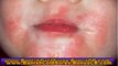banish cold soreshow to get rid of a cold sore fast - how to get rid of cold sores overnight - how to get rid of a cold sore overnight