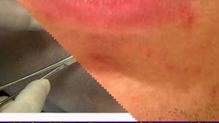 skin tag removal at home - how to get rid of skin tags - skin tags how to remove