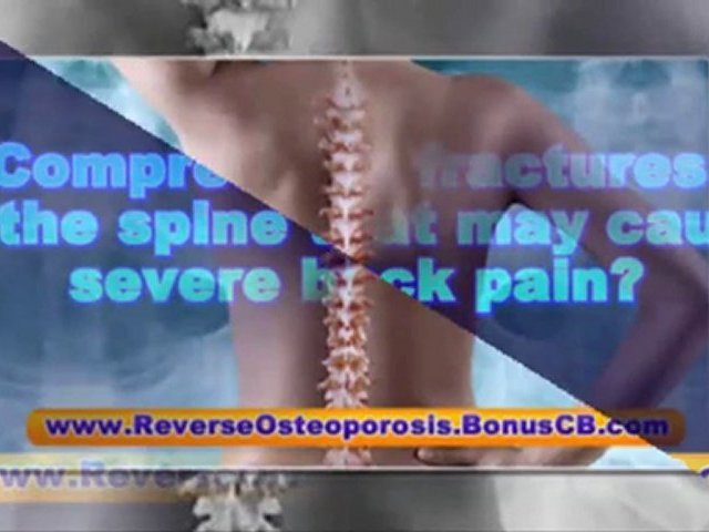 osteopenia treatment – osteoporosis guidelines – osteoporosis treatments