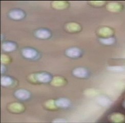 Образователно филмче "Перитонеална диализа" - превод