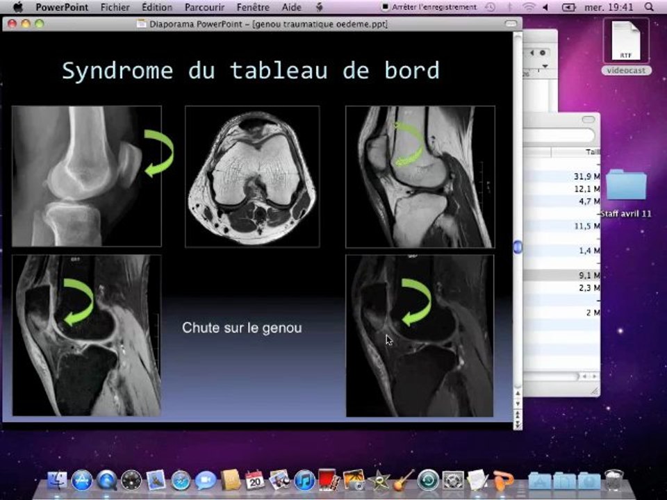 Contusions osseuses et mécanismes lésionnels
