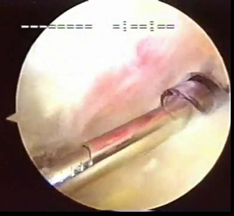 Arthroscopic Shoulder Surgery