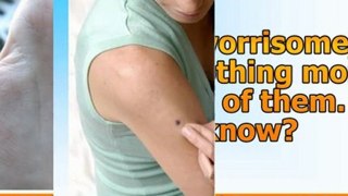how to get rid of a skin tag - how to remove skin tag - how to remove skin tags naturally