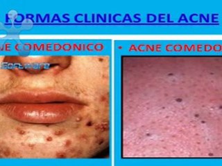FORMAS CLINICAS DEL ACNE