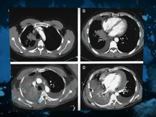 Asbestos West Chicago