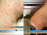 how to get rid of hives fast - treatment for hives in adults