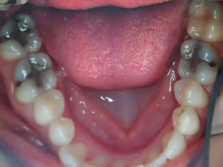 Replacing Old Silver Fillings CEREC Austin Tx- Lak