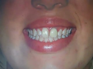 How to fix White Spots on Teeth Austin, Tx- Lakewa