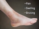 Ankle Sprains - Annapolis and Stevensville, MD  Podiatrist