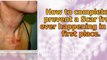 how to get rid of scars on face - acne scars home remedies - removing acne scars
